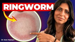 Ringworm: How to Tell If It’s Fungal (NOT Eczema) + Best Treatment (Doctor Explains) #rash