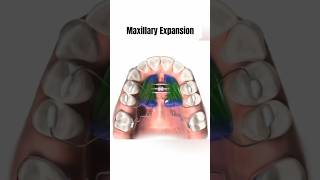 Maxillary Expansion, Orthodontics Devices