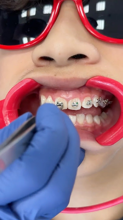 Watch how Metal Braces are put On