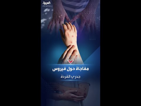 مفاجأة تفجرها وكالة بلومبيرغ حول فيروس جدري القردة