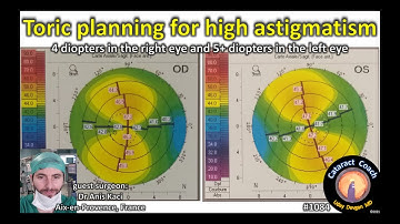 CataractCoach 1084: toric IOL planning for high corneal astigmatism