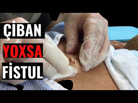 Video: Perilimfa fistula öz-özünə sağalırmı?