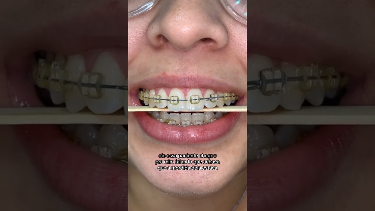 Mordida inclinada? #shorts