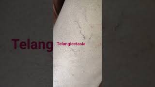 Are Disease Ociated With Telangiectasia
