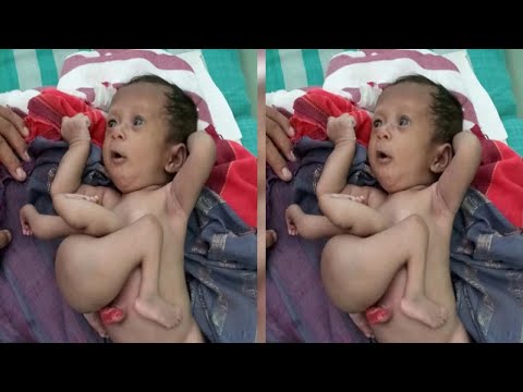 Video: I Medici Indiani Hanno Separato In Modo Sicuro Dal Bambino Di 7 Anni Il Suo Gemello Parassita - Visualizzazione Alternativa