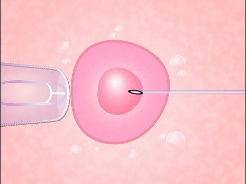 Vídeo: Novo grupo de apoio é lançado para casais de fertilização in vitro