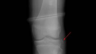 Segond Fracture