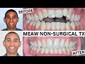 Open Bite Correction using Non Surgical MEAW Technique in Adult Male Patient- Testimonial w/Dr. Bass