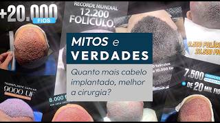 Mais cabelo transplantado não significa um resultado melhor. Saiba o porquê