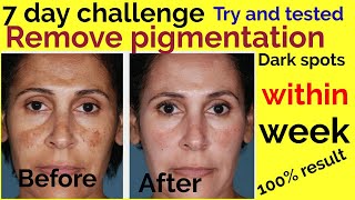 7 दिन में खत्म होगी झाईया,काले दाग|मेरा खुद का आजमाया हुआ घरेलू नुस्खा|Remove pigmentation easly