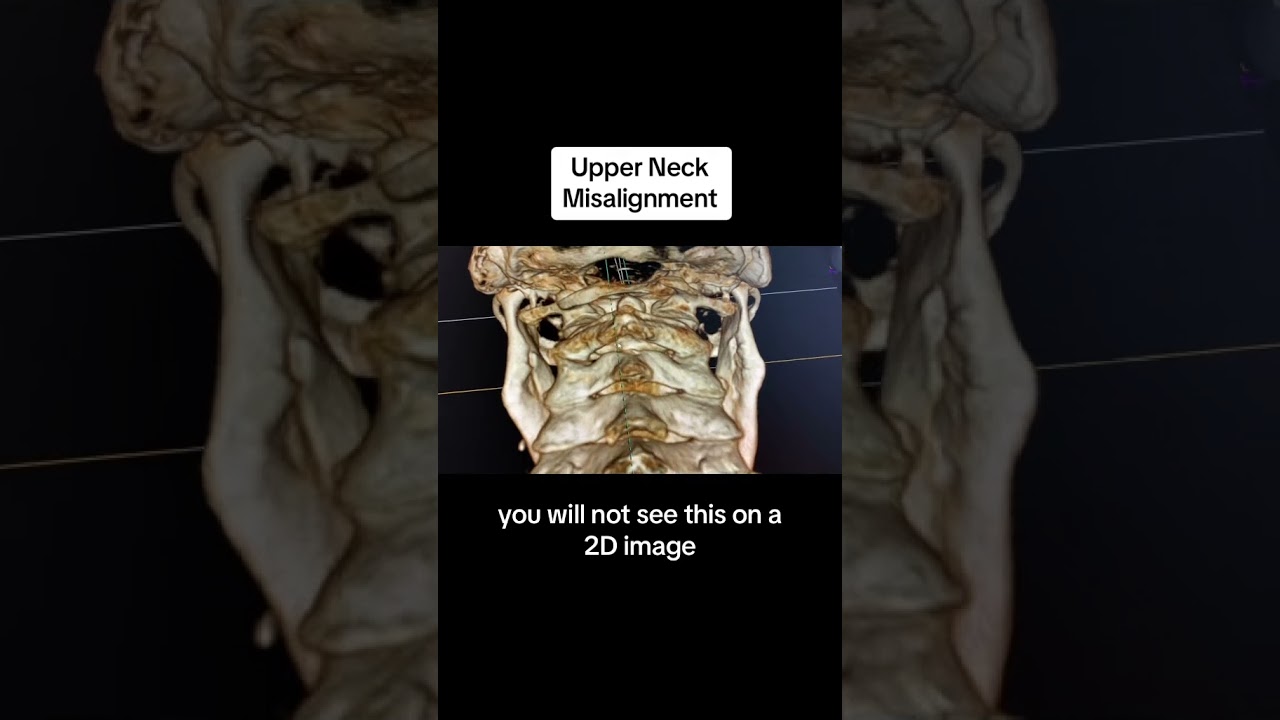 Upper Neck Misalignment Utilizing Advanced 3D Spinal Imaging via CBCT