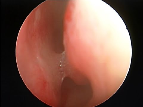 Endoscopic repair for nasal adhesion