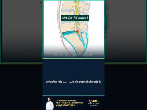 L5-S1: सबसे नीचे की Disc और क्यों है ये मुश्किल — बेस्ट एंडोस्कोपिक स्पाइन सर्जन, हैदराबाद