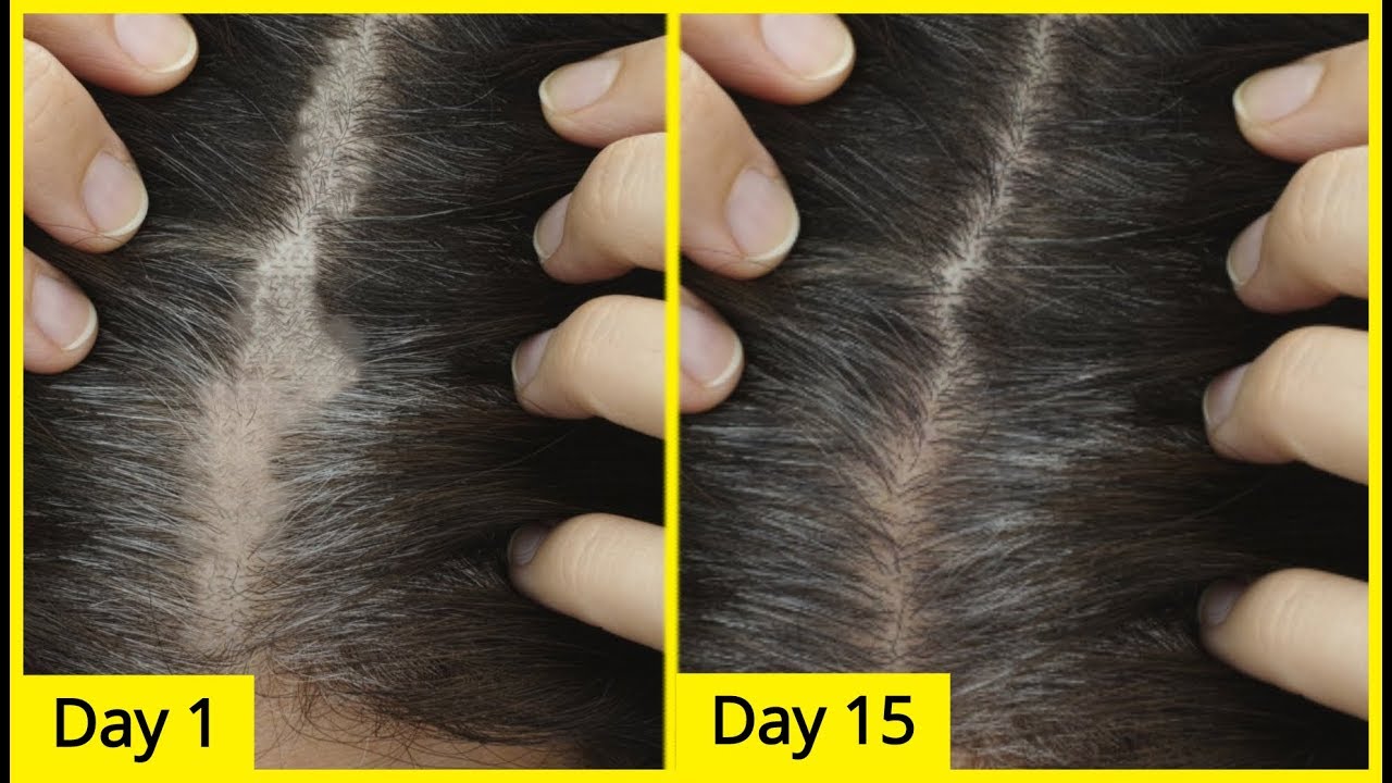 The Best Treatments and Solutions for Hair Regrowth