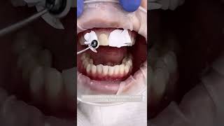 Watch how we deal with a dark front tooth using a direct composite veneer ☁️