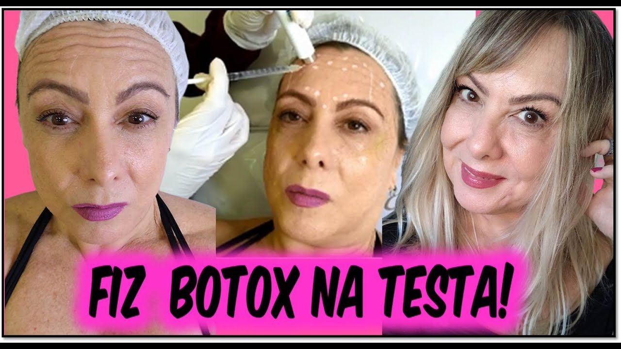 📢FIZ BOTOX NA TESTA l MEU ANTES E DEPOIS l DOEU? QUAL FOI O RESULTADO?