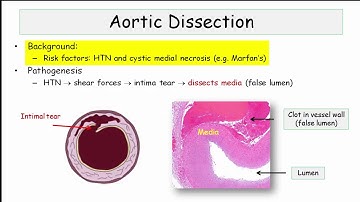 12DaysinMarch, Aortic Disorders (Part I) - Aneurysm and Dissection for USMLE Step One
