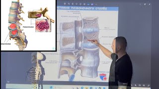 Гемангиома.Грыжа Шморля.Листез.Операция #гемангиома #грыжапозвоночника #миопрессура #грыжадиска