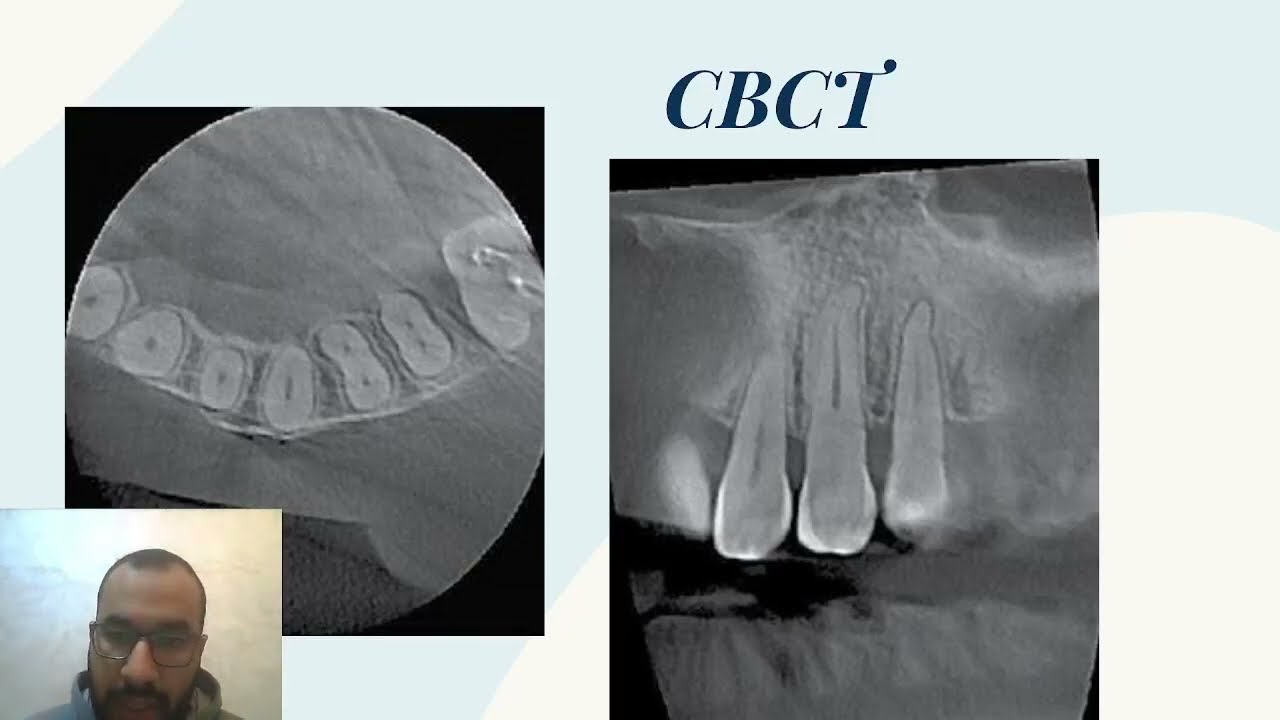 Management of Calcified Canals