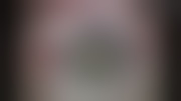 Dr. David Chang: ZEPTO® Capsulotomy in Floppy Iris Syndrome