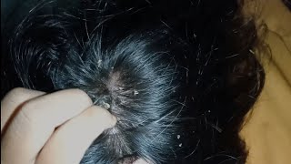 video satisfying relaxing || DRY SCALP!! big flakes dandruff scratching