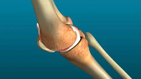 Medical Animation Video for Knee Replacement | Surgical Animation | 3D Medical Animation Studio
