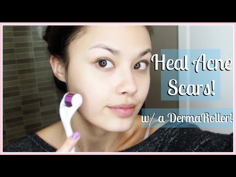 How to Treat Acne Scars (My Before and After) and Improve Your Skin&#;s Appearance