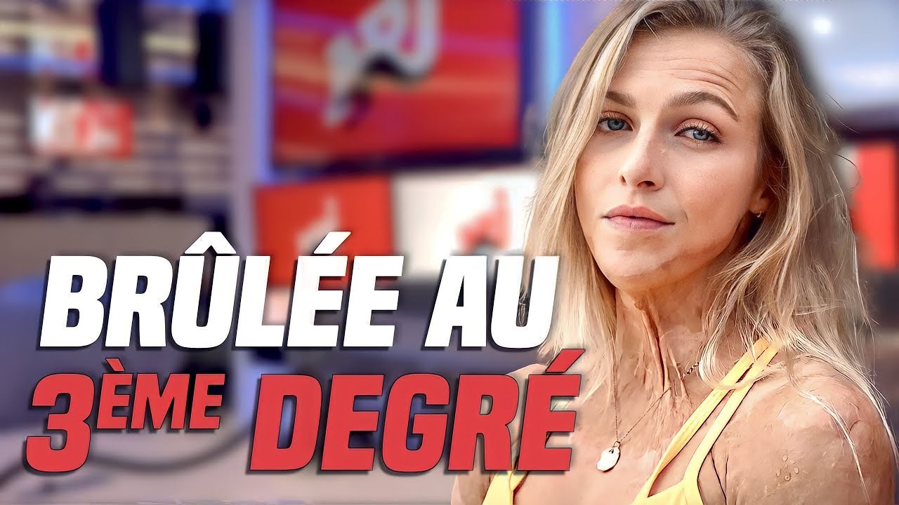 BRULÉE AU 3 ÈME DEGRÉE : JULIE NOUS RACONTE SON HISTOIRE