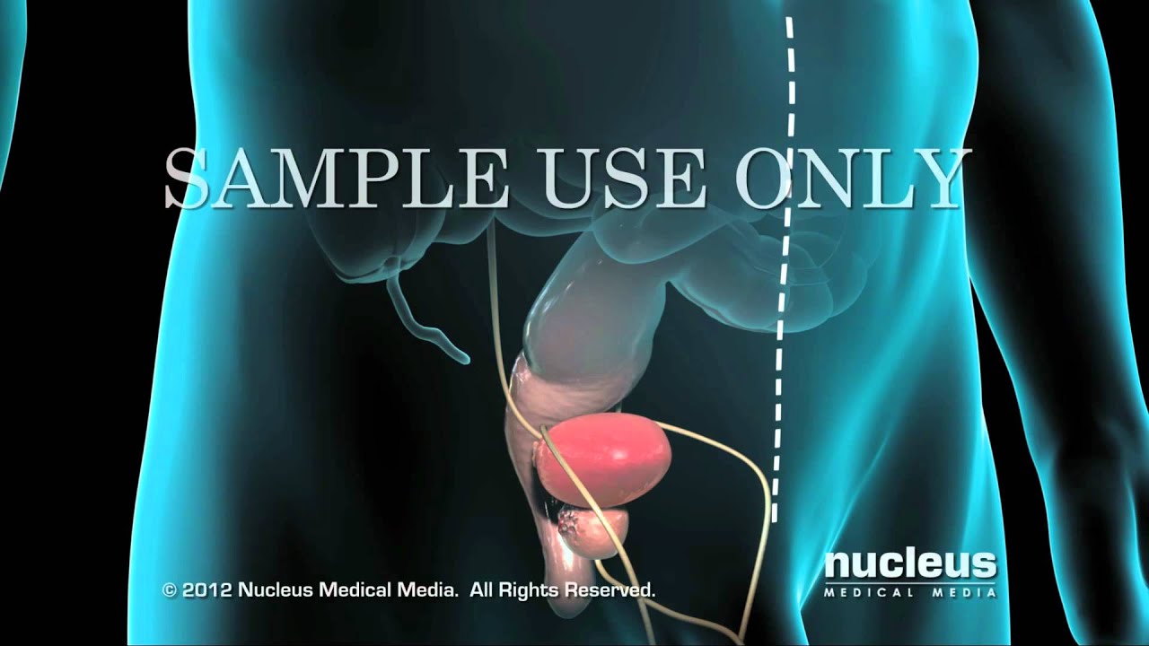 Prostatectomía radical - YouTube