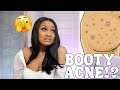 How to CLEAR BUTT ACNE FAST | Getting Rid of Body Acne, Scars, and Irritation!