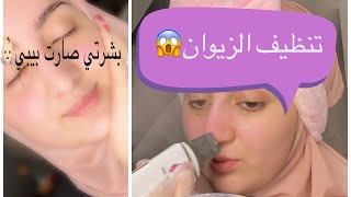 كيف اتخلص من الزيوان بخطوات بسيطة? تنظيف البشرة العميق في المنزل❤️