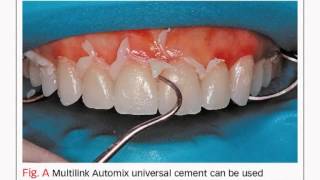 Bench Mastery: What You Need to Know About Cementation