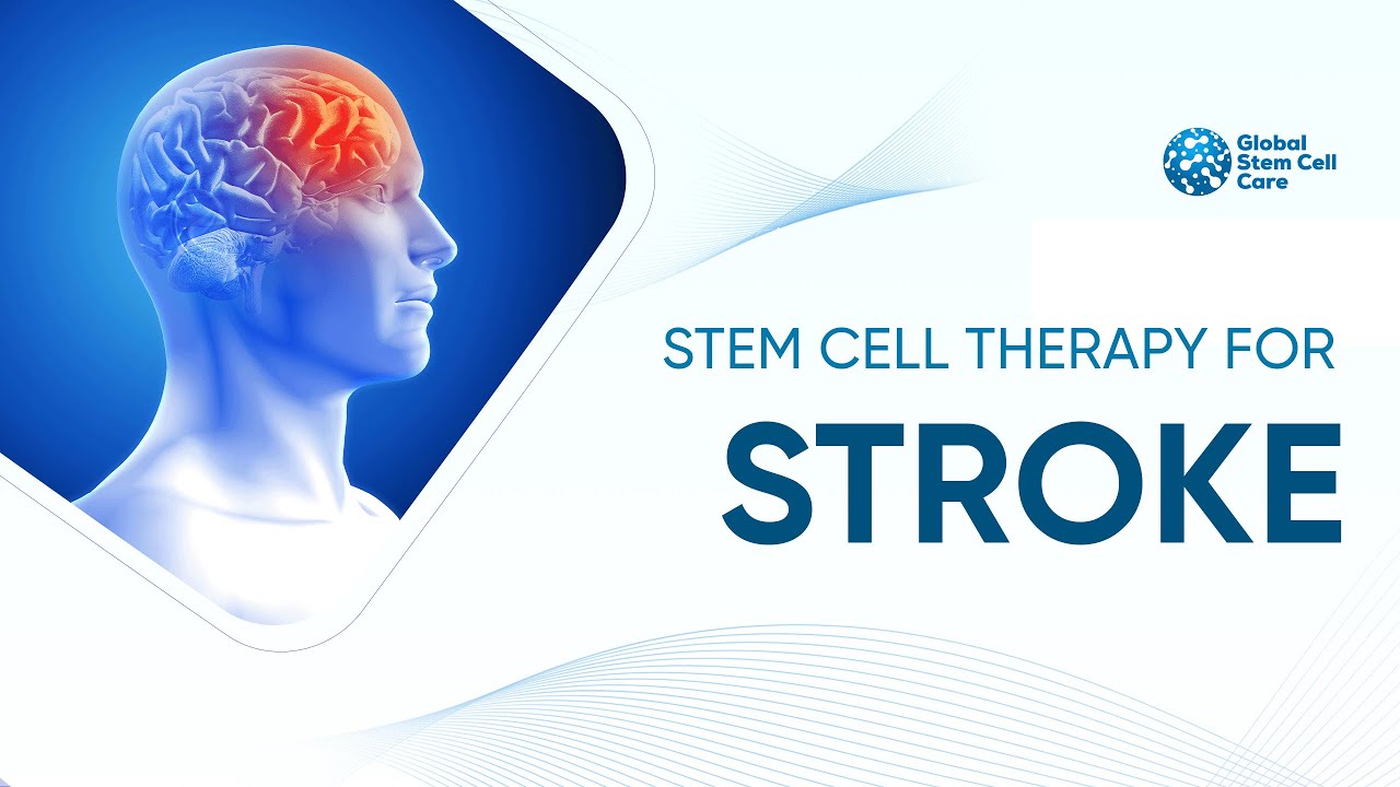 Stem Cell Therapy in Brain Stroke | Brain Stroke | Best Treatment For ...
