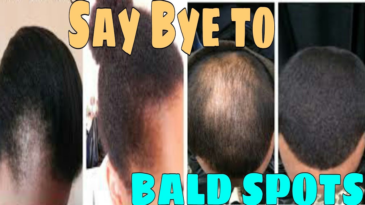 INSTANT HAIR GROWTH WOMEN AND MEN Dr Fill It YouTube