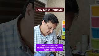 Mole, Wart Removal without Scar | CO2 Laser Safe Treatment