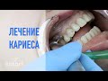 Лечение кариеса, постановка пломбы | Стоматология в Самаре