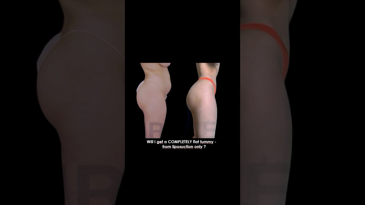 Will I get a completely flat tummy with liposuction alone?