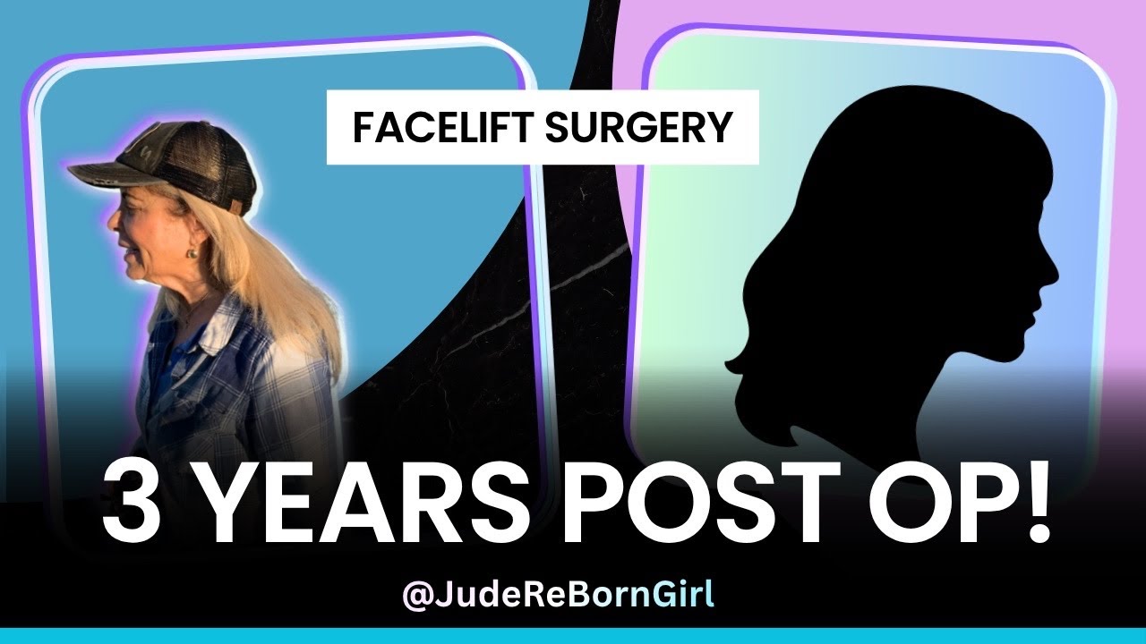 My Facelift Results 3+ Years post-op!