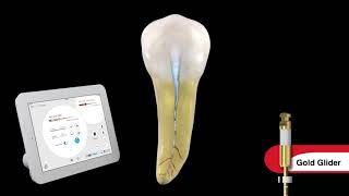 Endodontic Canal Preparation with Dr. Ruddle