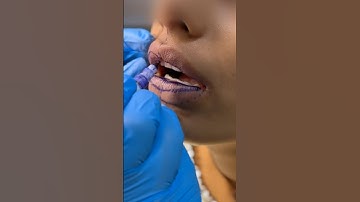 Lip 👄 Reduction Surgery | #lip #lipreduction #drshalupunj