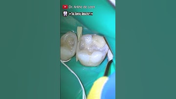 Restoring 2 teeth at a time