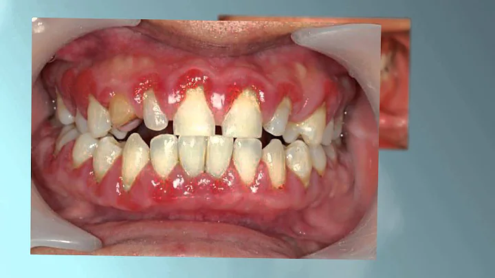 Berrien Dental Lays Out Gum Disease Risk Factors