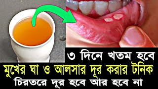 দ্রুত মুখের ঘা ও আলসার সারানোর সহজ উপায়। মুখে ঘা হলে এটি ব্যবহার করুন ৫ মিনিটেই রেজাল্ট পাবেন