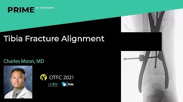Tibia Fracture Alignment - Charles Moon, MD