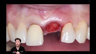 Clinical Case 10-Anterior Implant Placement with 3D Printed Provisional