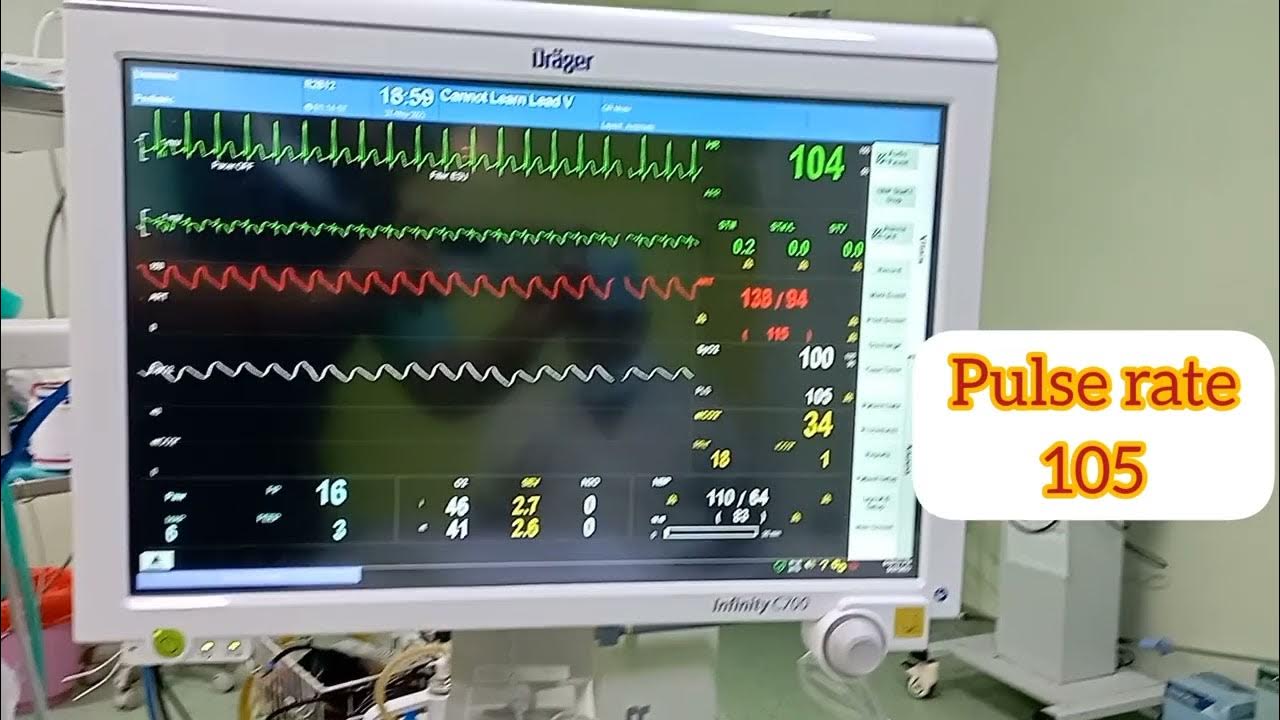 ICU Monitor Read... Heart rate, Pulse rate, B. P. & Etco2 , Oxygen