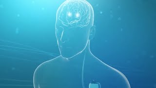 Treating Parkinson’s with Deep Brain Stimulation (DBS)