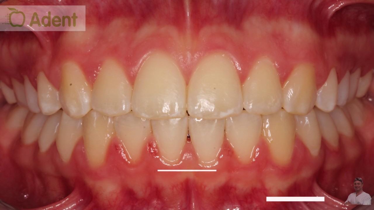 Orthodontie avant/après YouTube