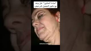 ميادة الحناوي قبل وبعد مع الدكتور التجميل نادر صعب