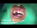 [English Dentist] Seoul Dental Clinic Front Dental Implant